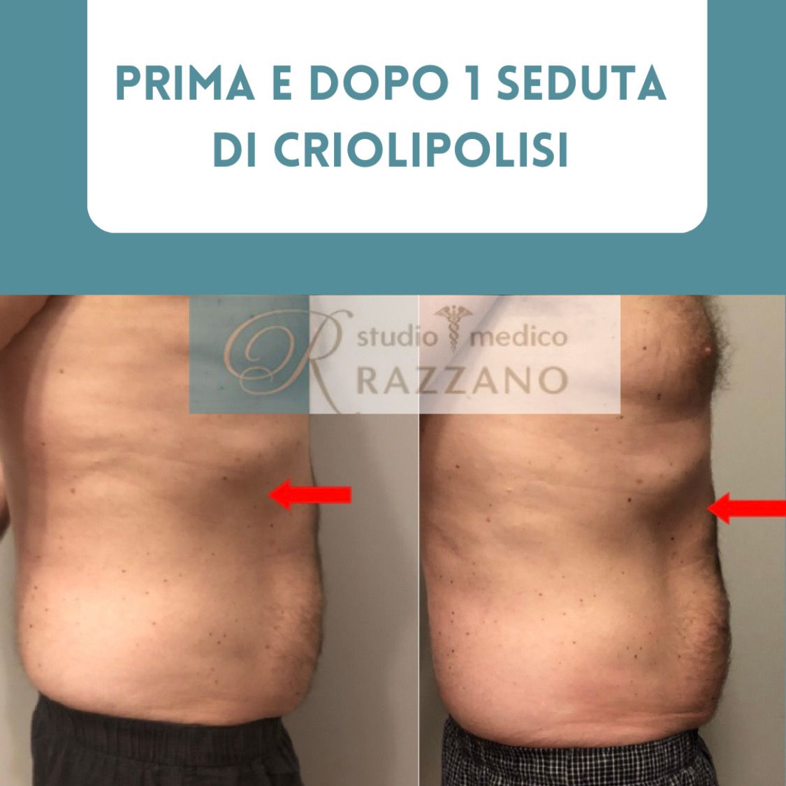 Criolipolisi e adiposità localizzate Monica Razzano